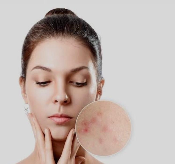 Facial acne lengkap + PDT 